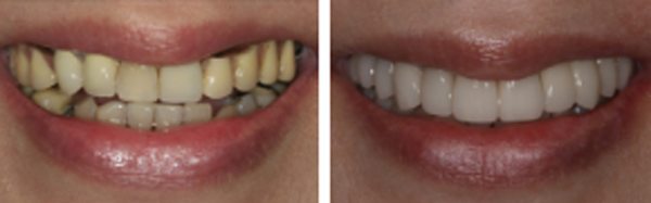 Before and after Dental Treatment