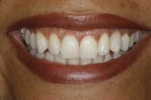 resin-bonded-bridge-after-300x200