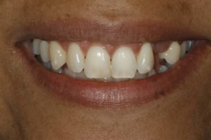 resin-bonded-bridge-after-300x200