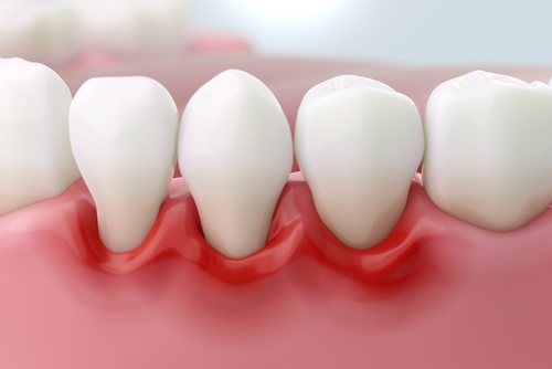Gum,Disease,And,Inflammation,From,Periodontitis,Or,Gum,Recession