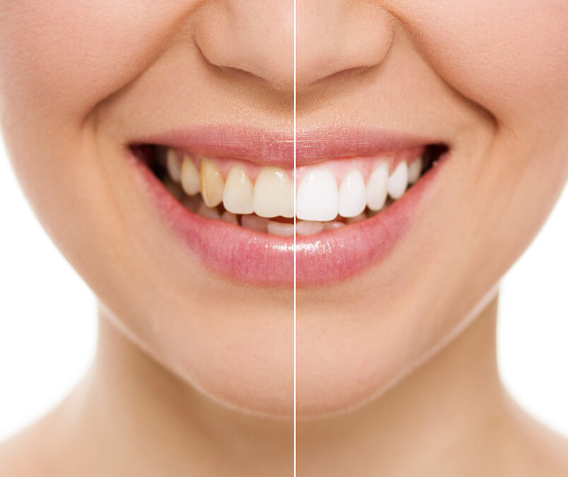 FAQs About Zoom Teeth Whitening