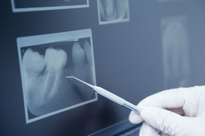 FAQs About Dental X-Rays