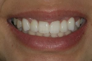 woman smiling after dental treatment
