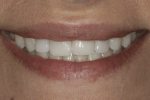 teeth whitening results