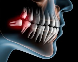 wisdom tooth illustration