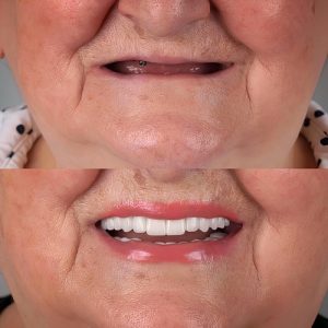 woman before and after dentures
