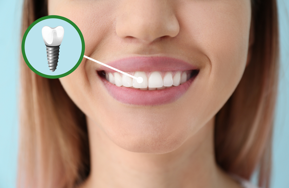 woman with a dental implant