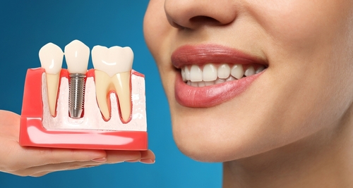 woman smiling with dental implant