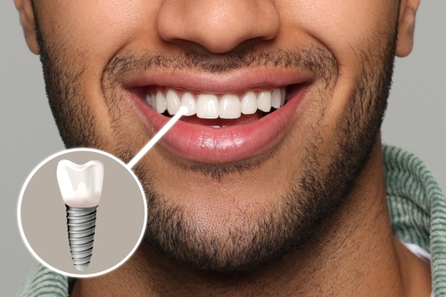 man with dental implant