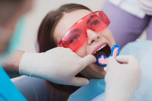 fluoride treatment