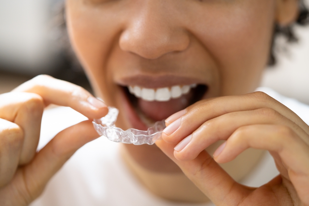 aligners